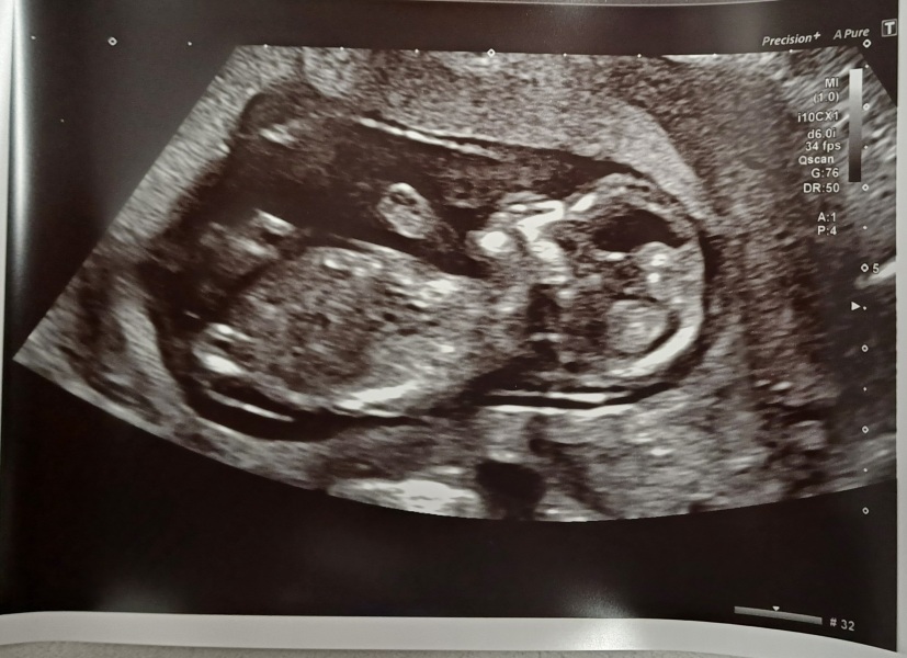 Nub theory - sex of baby?
