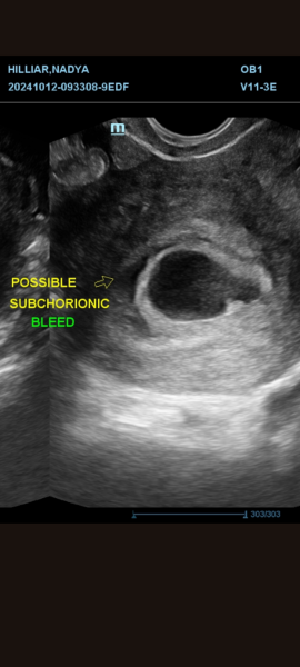 Subchorionic Hematoma