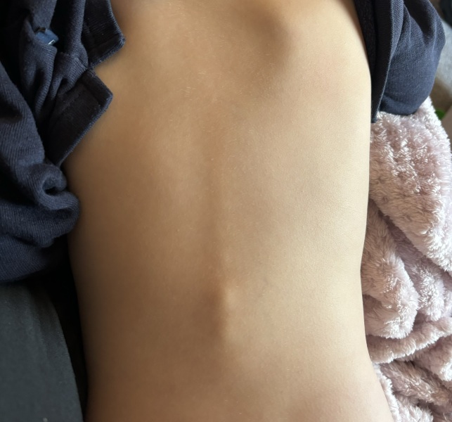 Toddlers spine shows a little