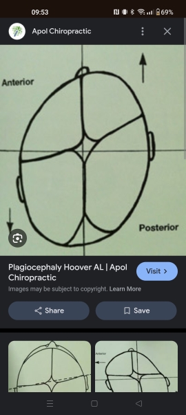 What side should I lay my baby if she has plagiocephaly?