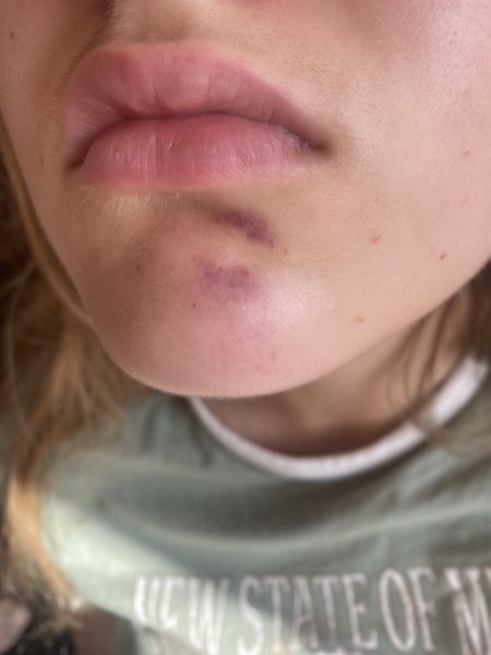 Woke up with this bruise on her chin? !!