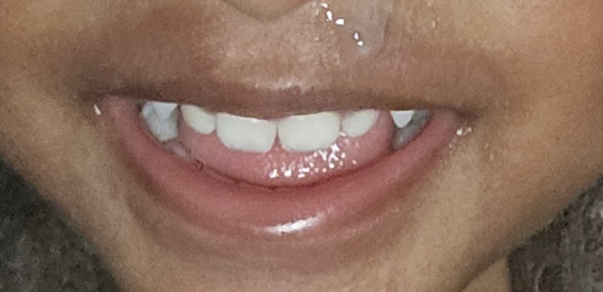 Dark hue around daughters mouth