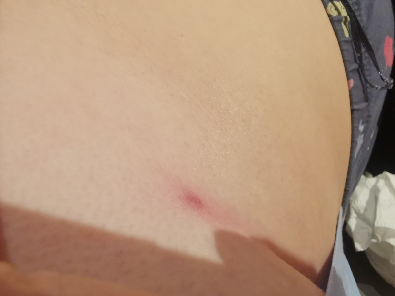 Red spot under breast! Help
