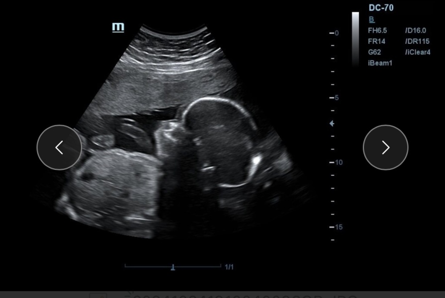 Baby scan