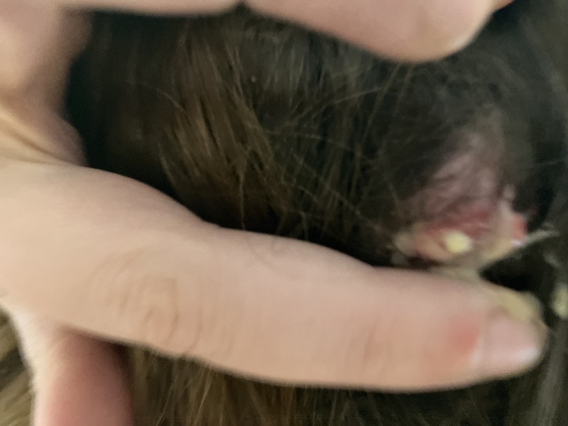 I think I have a cyst on top of my cyst (pics)