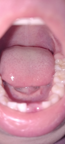 6 year molars