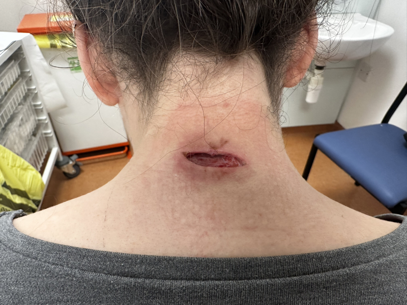 Mother of all sebaceous cysts