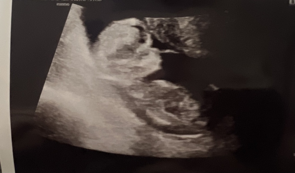 1 in 58 chance of Down syndrome