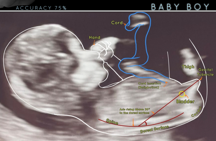 Boy or girl scan