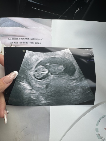 Any gender guesses ? 10 weeks 3 days