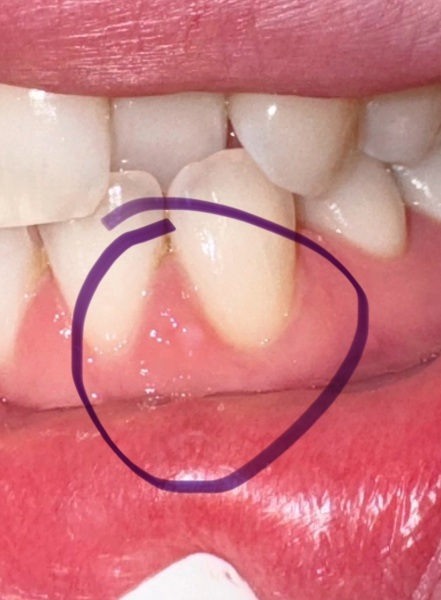Any dentists around? Weird white lump, pic included