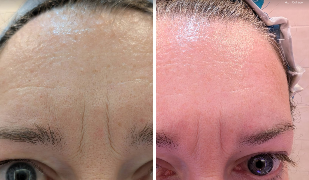 Tretinoin 0.006 - I think I can see an improvement already!! (Pic)