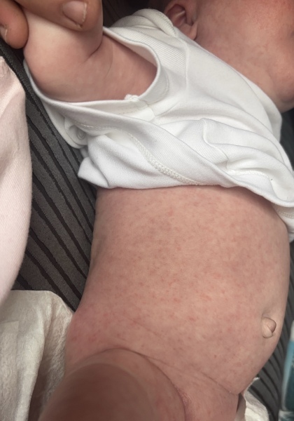 ? Milk allergy rash?