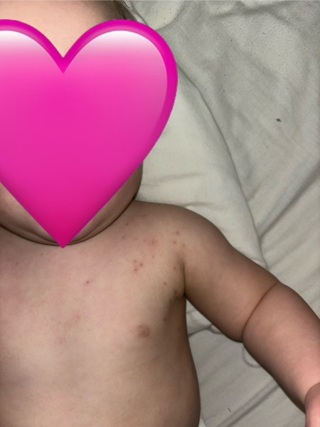 Is this chicken pox?