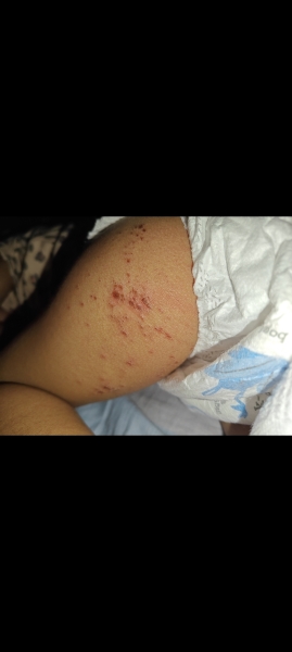 Impetigo or Eczema herpeticum? So worried about 21 month old DH (pic included)