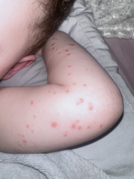 Hand foot and mouth advice needed