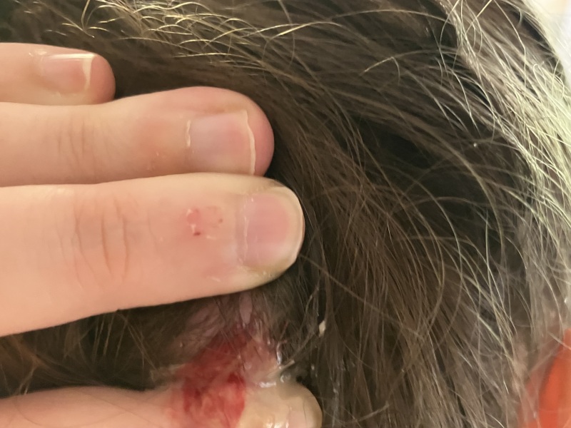 I think I have a cyst on top of my cyst (pics)