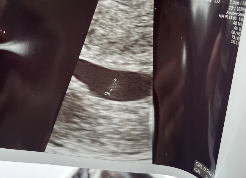 6 week scan - faint fetal pole