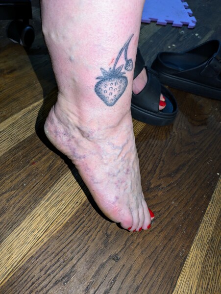 Varicose veins, but my foot has looks awful today! - GP?  (Photo)