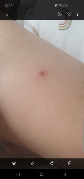 Chicken pox or bug bites