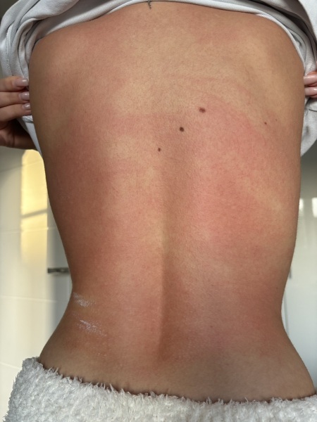 To take dd to out of hours with this rash?