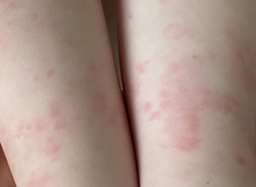 Rash on 1 year old
