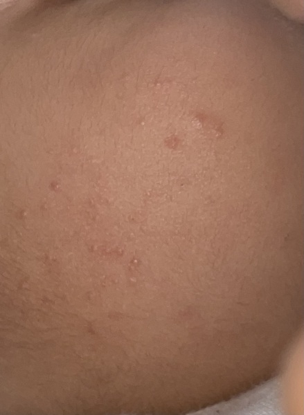 Raised Spot on 9 month old cheeks