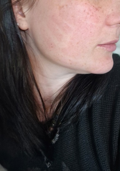 I had laser treatment for rosacea today but I've just noticed indentations on my cheeks.