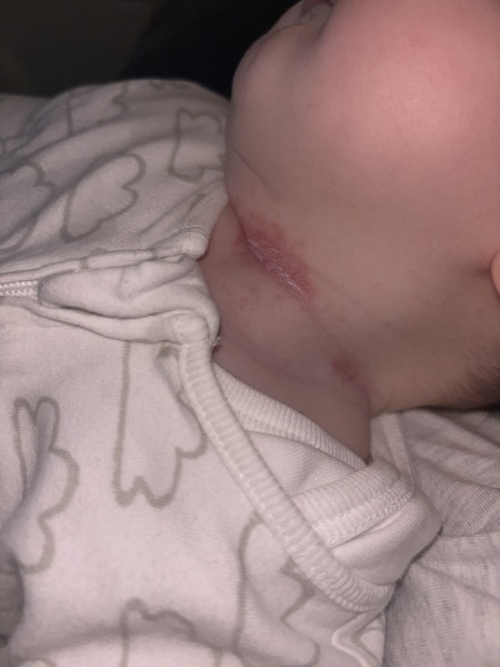 Redness on my babies neck