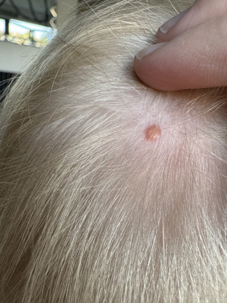 Orange scalp spots