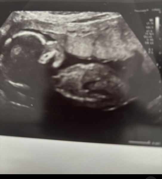 Nub or umbilical cord ?