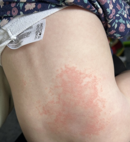 Rash on 12 month olds back