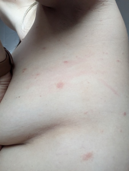 What's this rash? Photo of side