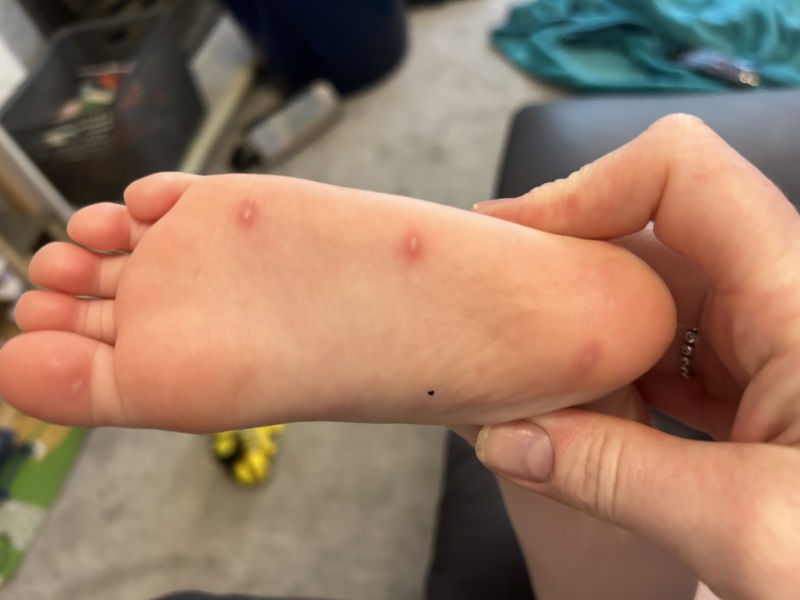 Chicken pox on foot