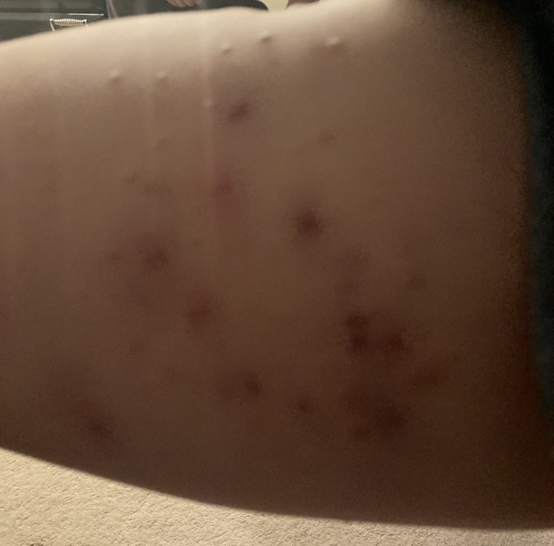 To ask for advice re this rash