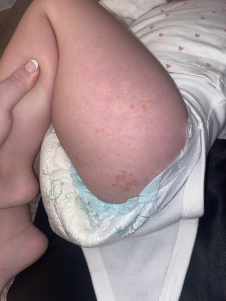 Is this hand foot and mouth?