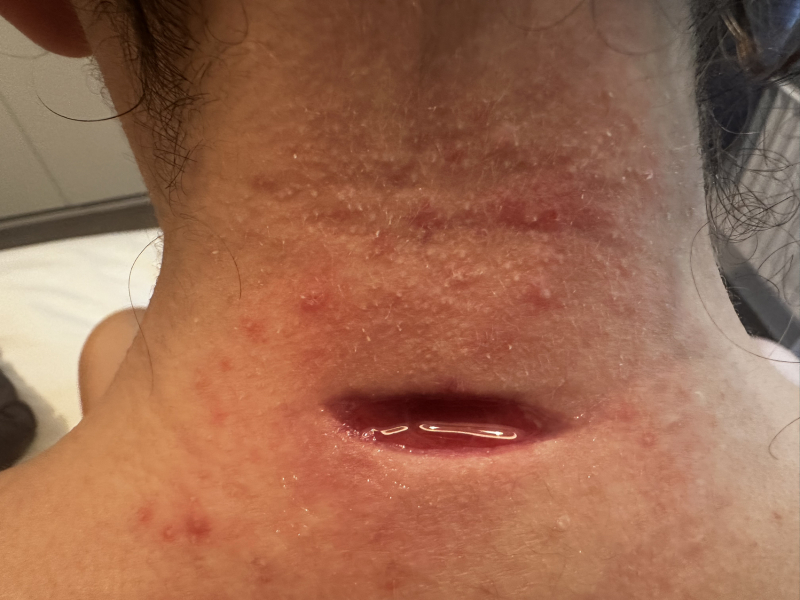 Mother of all sebaceous cysts