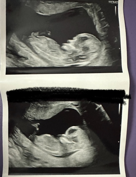 Sex of baby