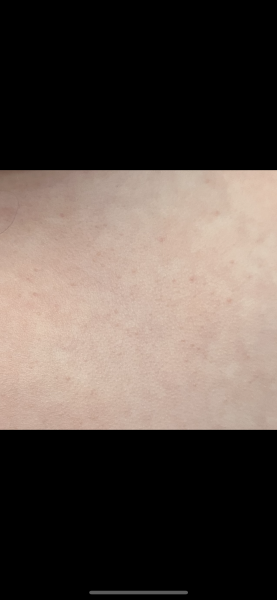 Baby rash