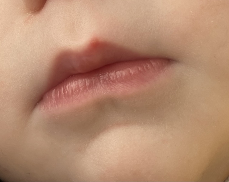 Cold sore?