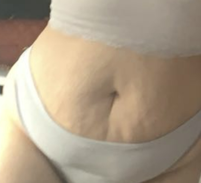 Has anyone lost 4 - 5st and got loose skin?