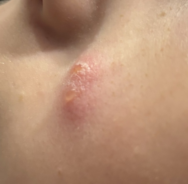 Can it be chicken pox with just one spot?