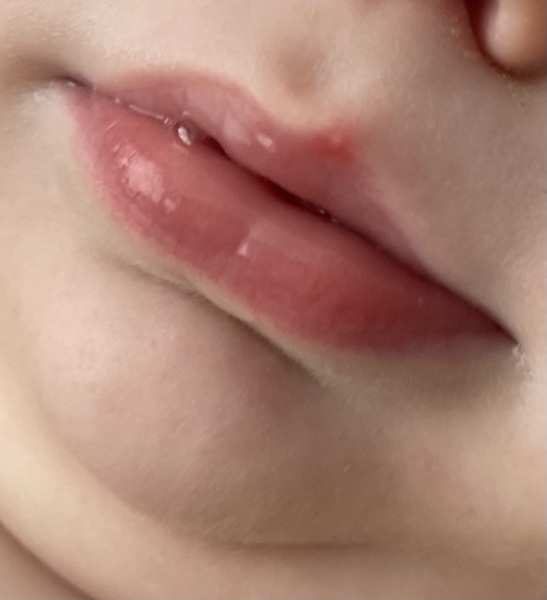 Cold sore?