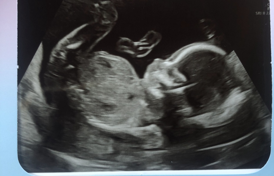 Boy or Girl Predictions 🤩