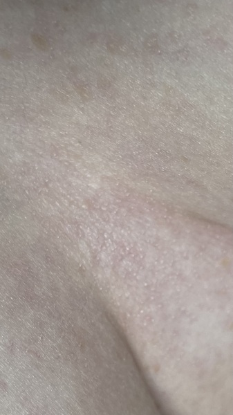 Between boobs sweat itch