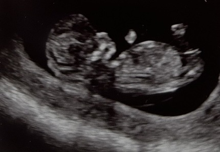 Nub Theory - Boy or Girl?