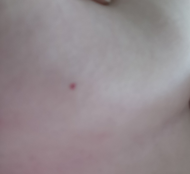 What is this red spot on my left breast? Pic attached