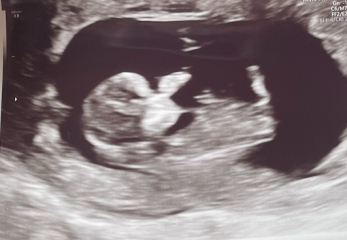 Boy or girl scan