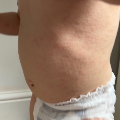 Baby rash
