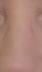 Well-meaning but ultimately misguided comments about my facial BCC